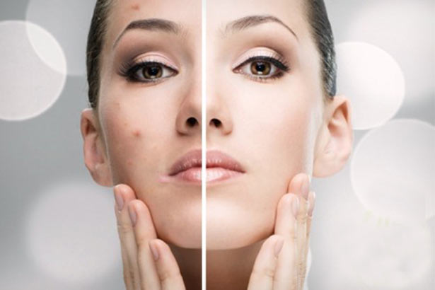 GIẢI PHÁP TRỊ THÂM VÀ SẸO MỤN HIỆU QUẢ
