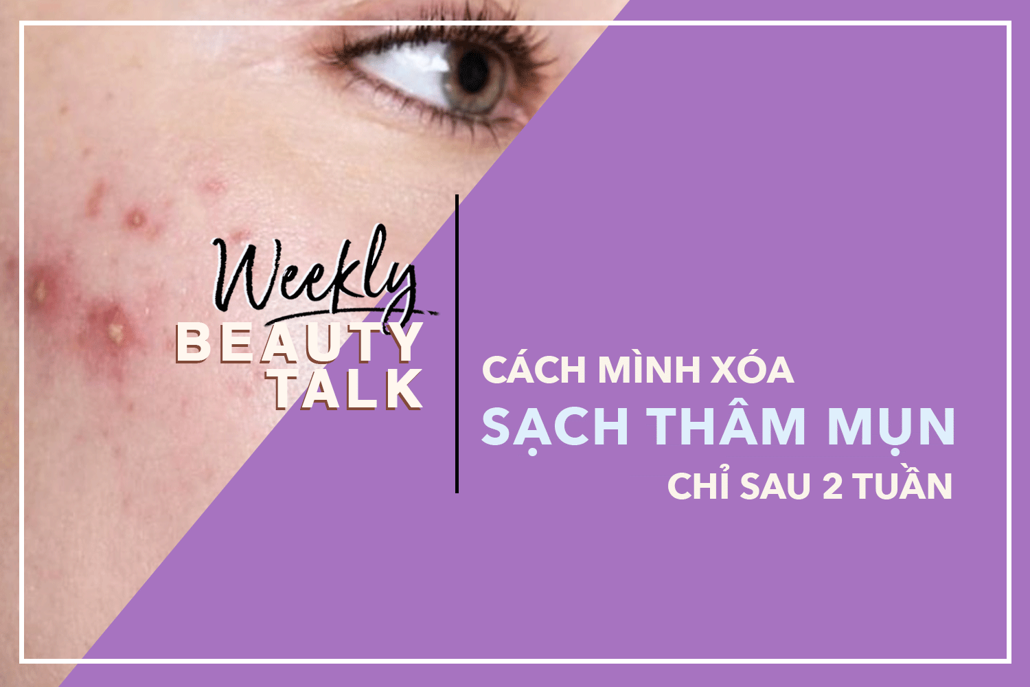 Bí quyết "thủ tiêu" thâm mụn sau 2 tuần với quy trình dưỡng da cực đơn giản