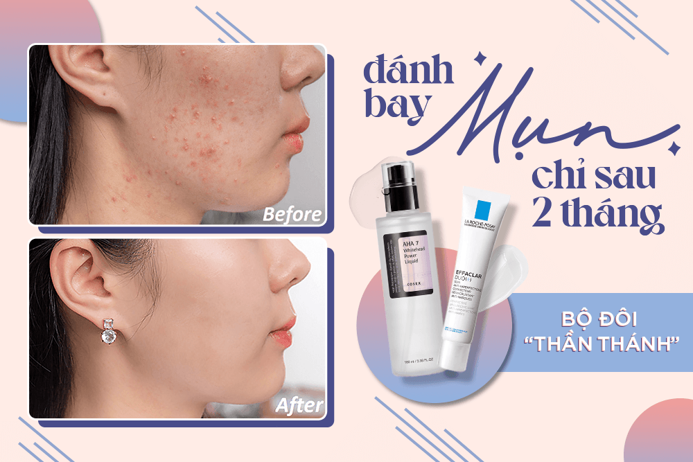 Chỉ với combo dưới dây, sau 2 tháng “hô biến” da mụn thành da láng mịn, mượt mà khó tin