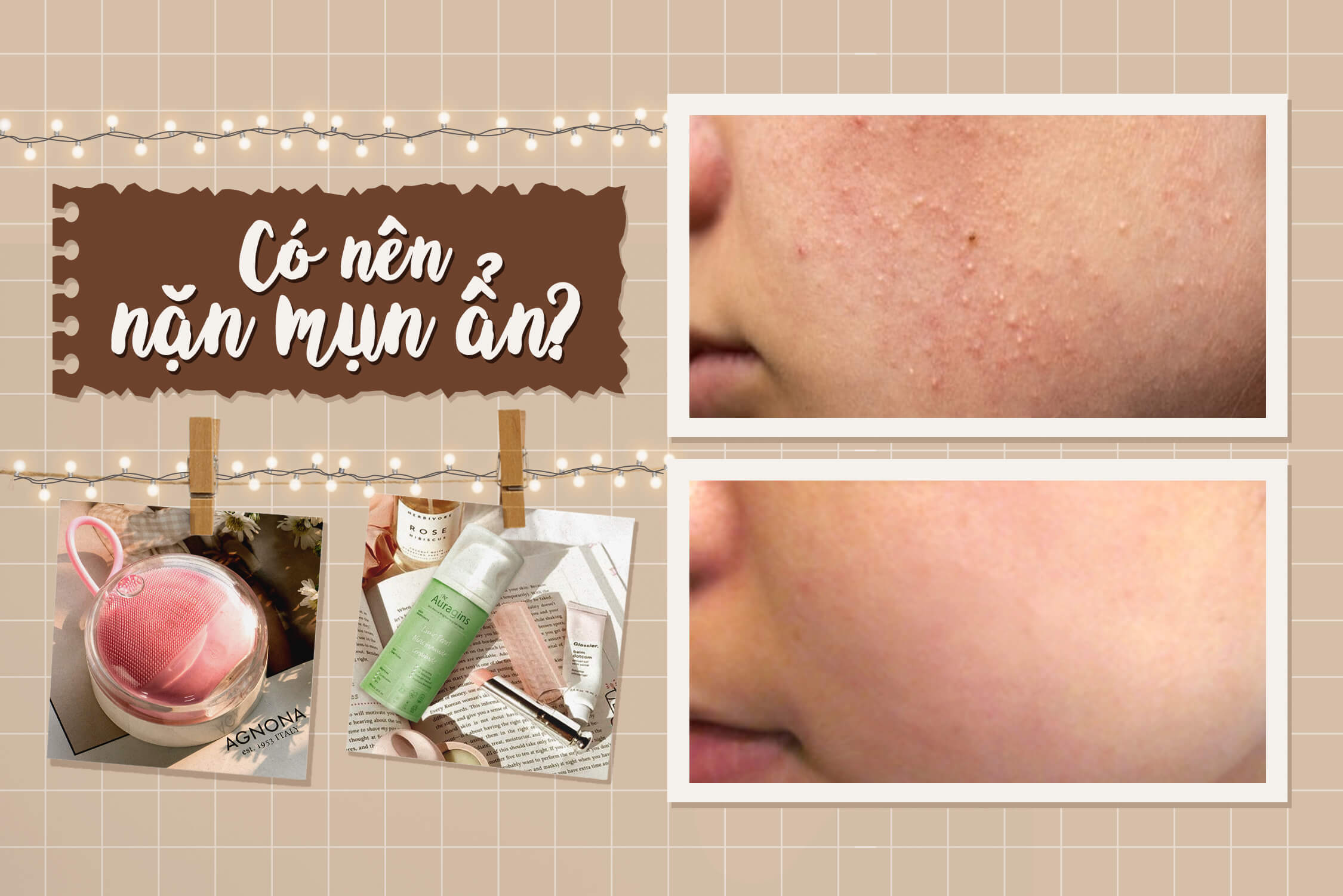 Câu hỏi mà ngay cả các beauty blogger cũng đau đầu “Mụn ẩn có tự biến mất không?”