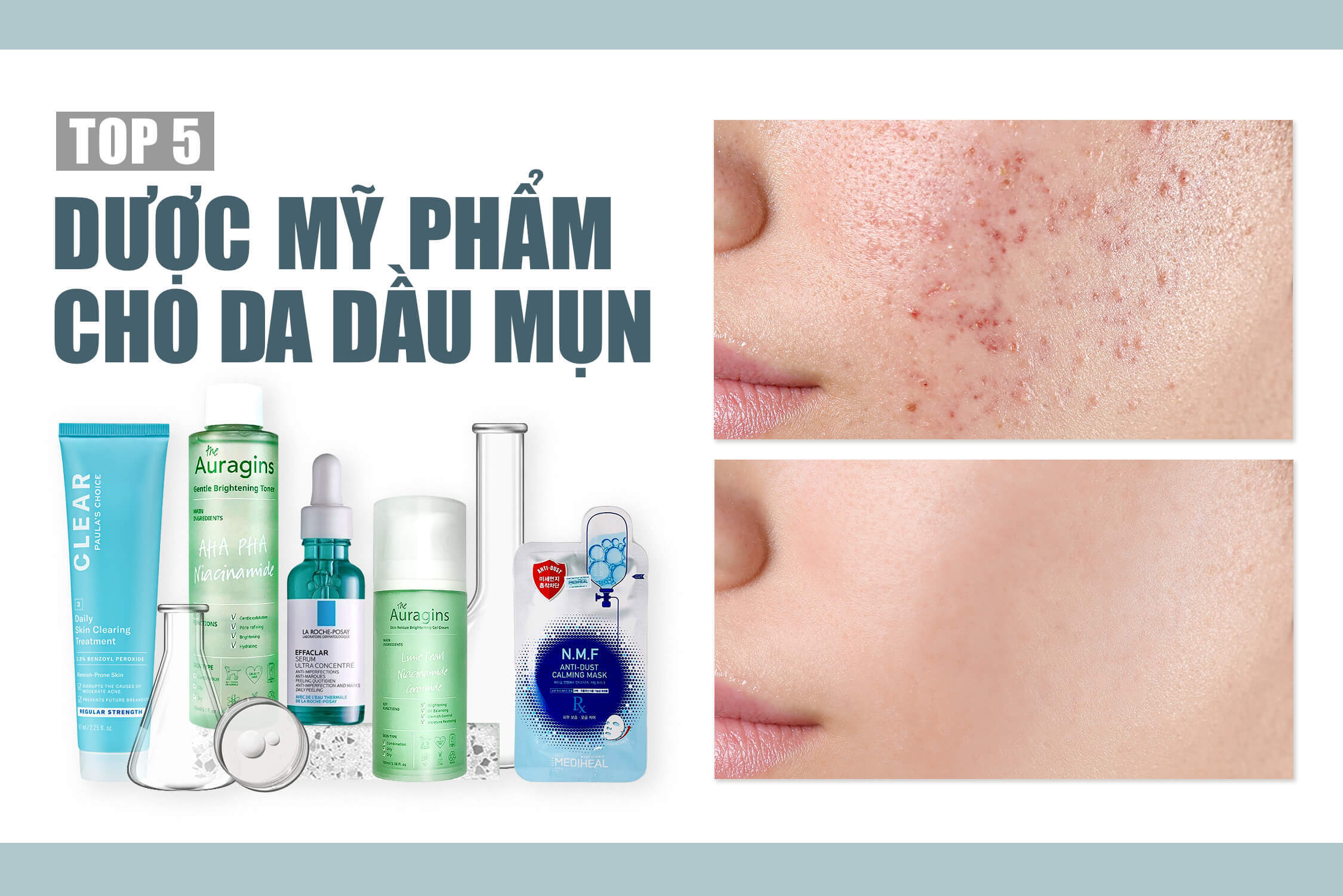 Da dầu mụn cẩn thận khi chọn mỹ phẩm. Xem ngay 5 thương hiệu dược mỹ phẩm thay đổi làn da bạn!