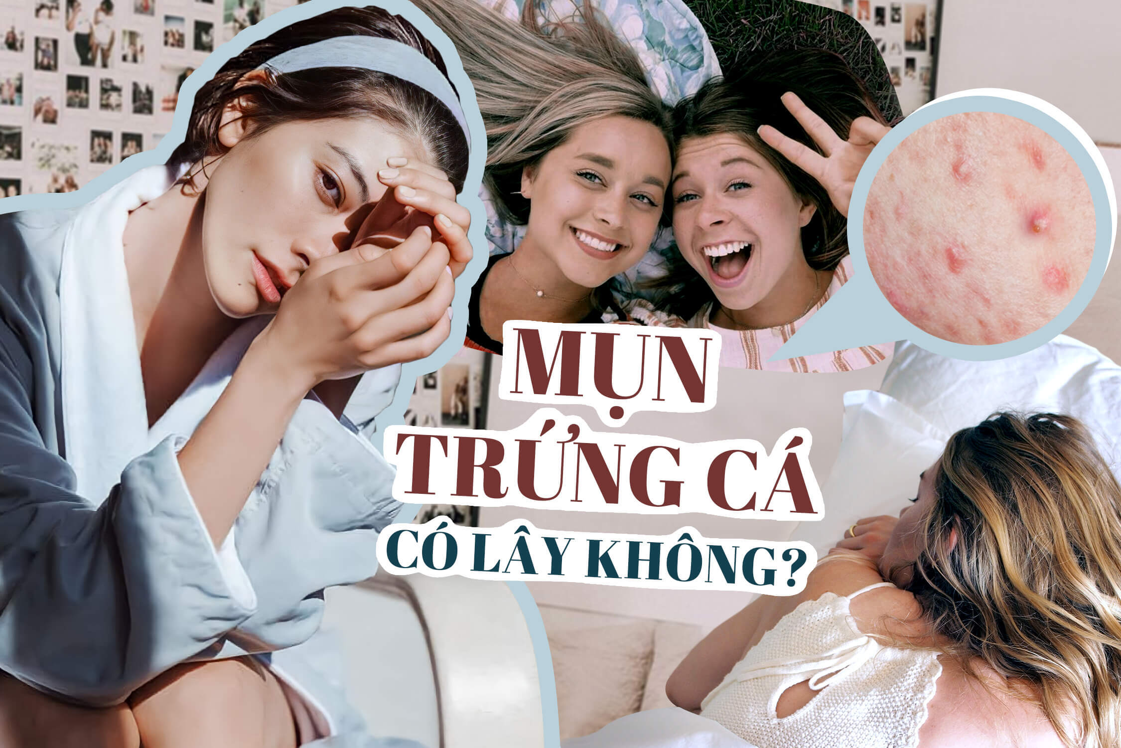 Câu hỏi tưởng dễ, ai ngờ hội skincare lâu năm cũng “lú lẫn”: Mụn trứng cá lây không?