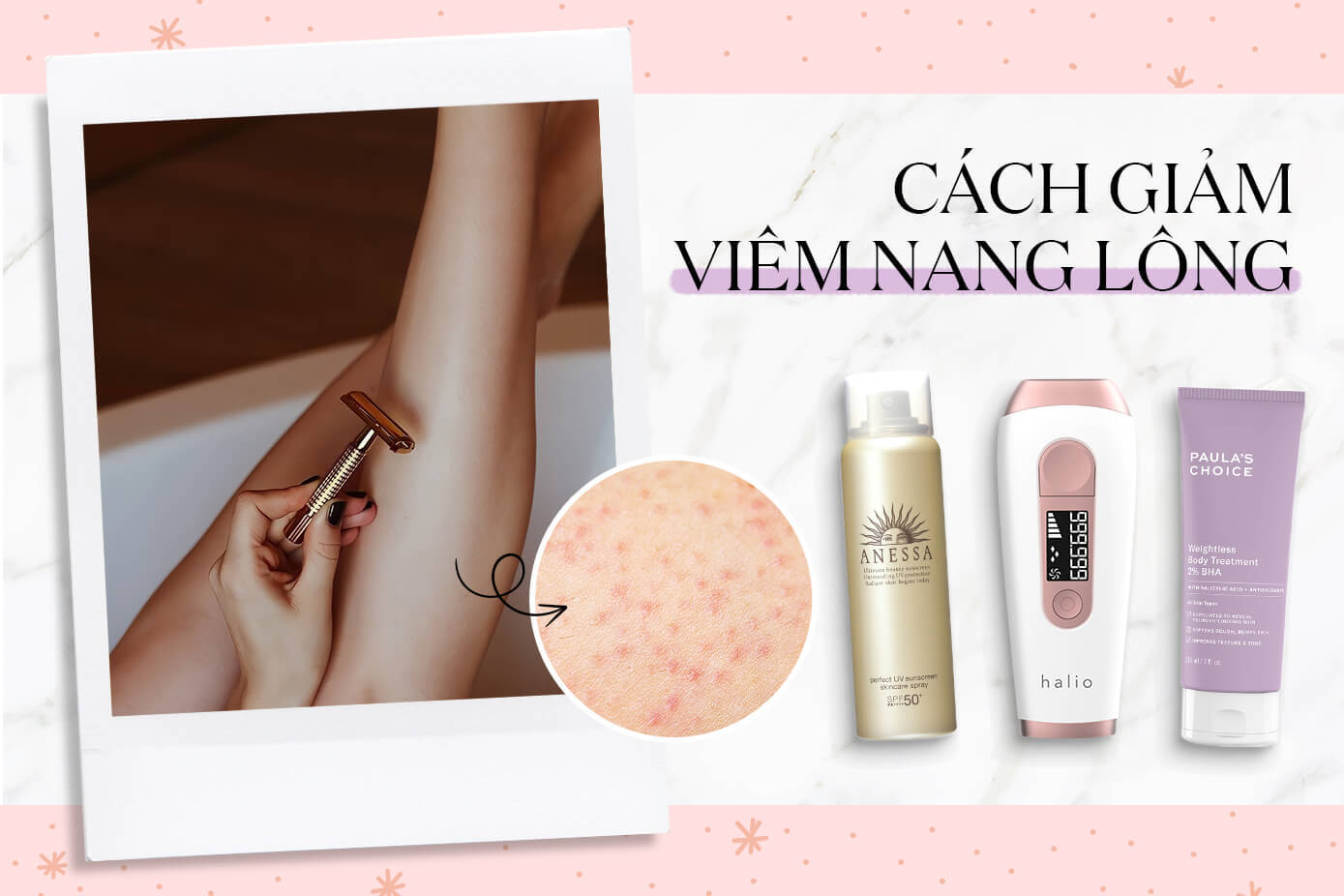Mách bạn 3 mẹo cực đơn giản để đánh bay viêm nang lông, tìm lại làn da láng mịn