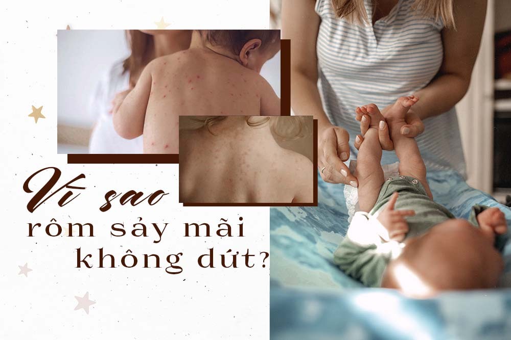 Thời tiết cuối năm se lạnh mà bé vẫn bị rôm sảy, mẹ xem ngay có mắc 4 sai lầm sau