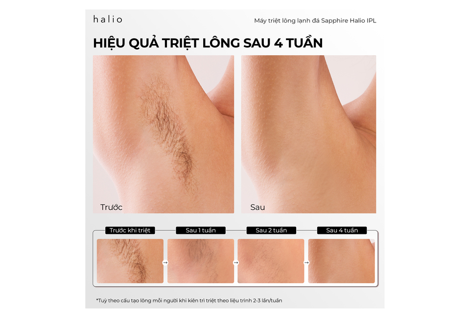 Hiệu quả triệt lông của Máy Triệt Lông Lạnh Sapphire Halio InfinityGlow Advanced IPL sau 4 tuần, có hình ảnh trước và sau khi triệt. Kèm theo hình ảnh kết quả từng tuần cho thấy làn da mịn màng hơn.