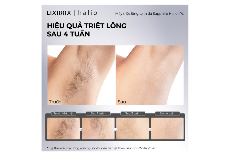 Kết quả triệt lông sau 4 tuần với Combo Triệt Lông Mát Lạnh. Hình ảnh so sánh trước và sau khi sử dụng máy triệt lông Sapphire Halio IPL. Cận cảnh sự thay đổi sau 1 tuần, 2 tuần và 4 tuần.