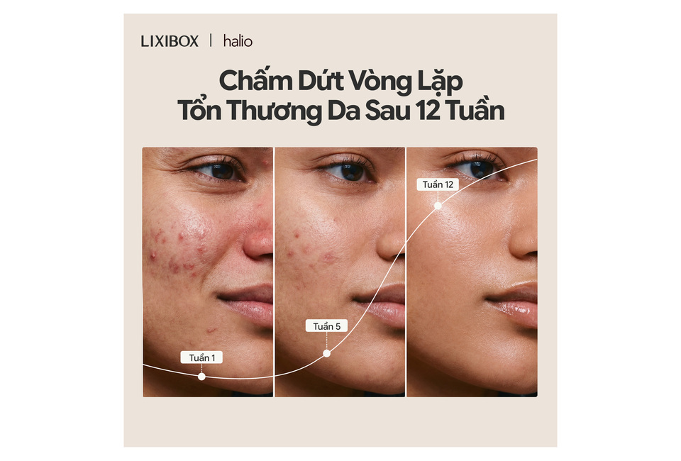 Hình ảnh mô tả quá trình cải thiện tình trạng da sử dụng Máy Phức Hợp Ánh Sáng Đa Tầng Halio Pro trong 12 tuần, thể hiện sự thay đổi của làn da qua các tuần từ 1 đến 12.