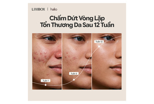 Hình ảnh mô tả quá trình cải thiện tình trạng da sử dụng Máy Phức Hợp Ánh Sáng Đa Tầng Halio Pro trong 12 tuần, thể hiện sự thay đổi của làn da qua các tuần từ 1 đến 12.